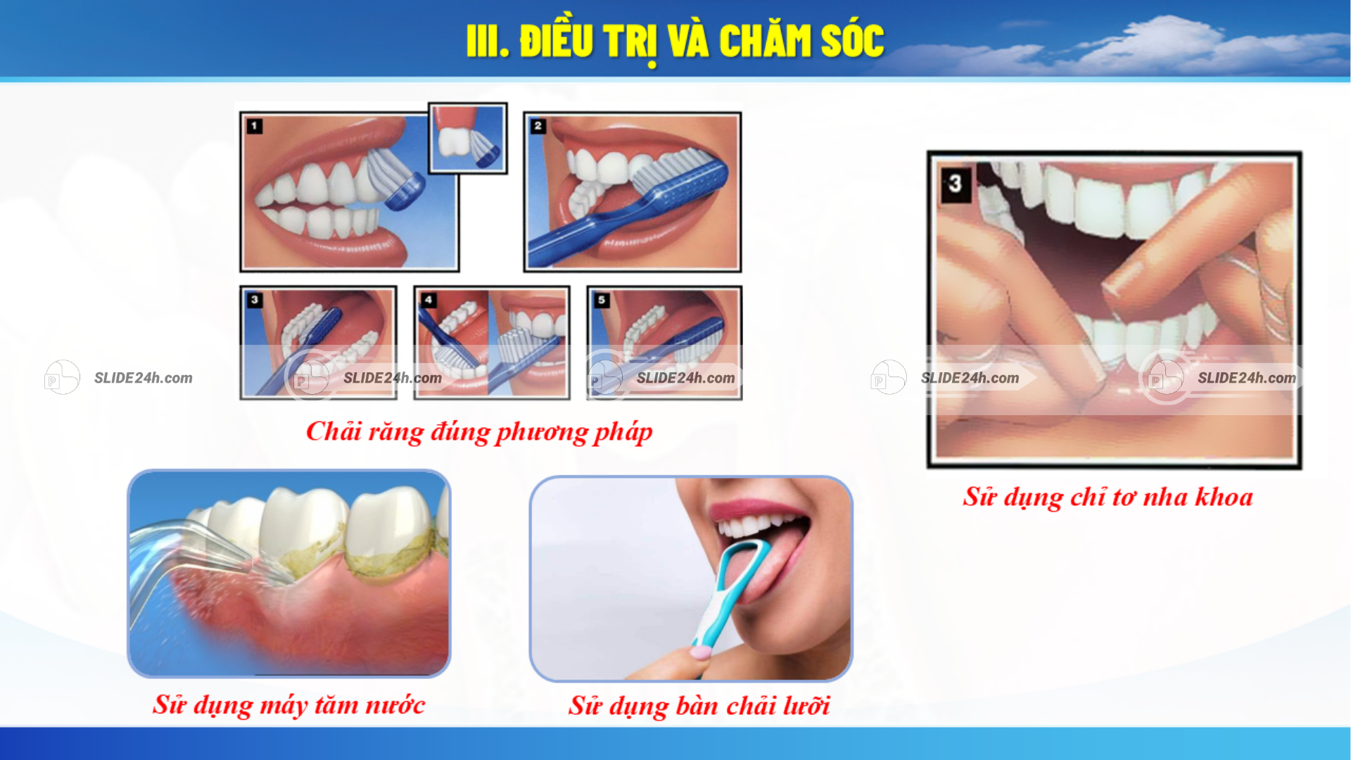 Các biện pháp chăm sóc và phòng ngừa viêm quanh răng.