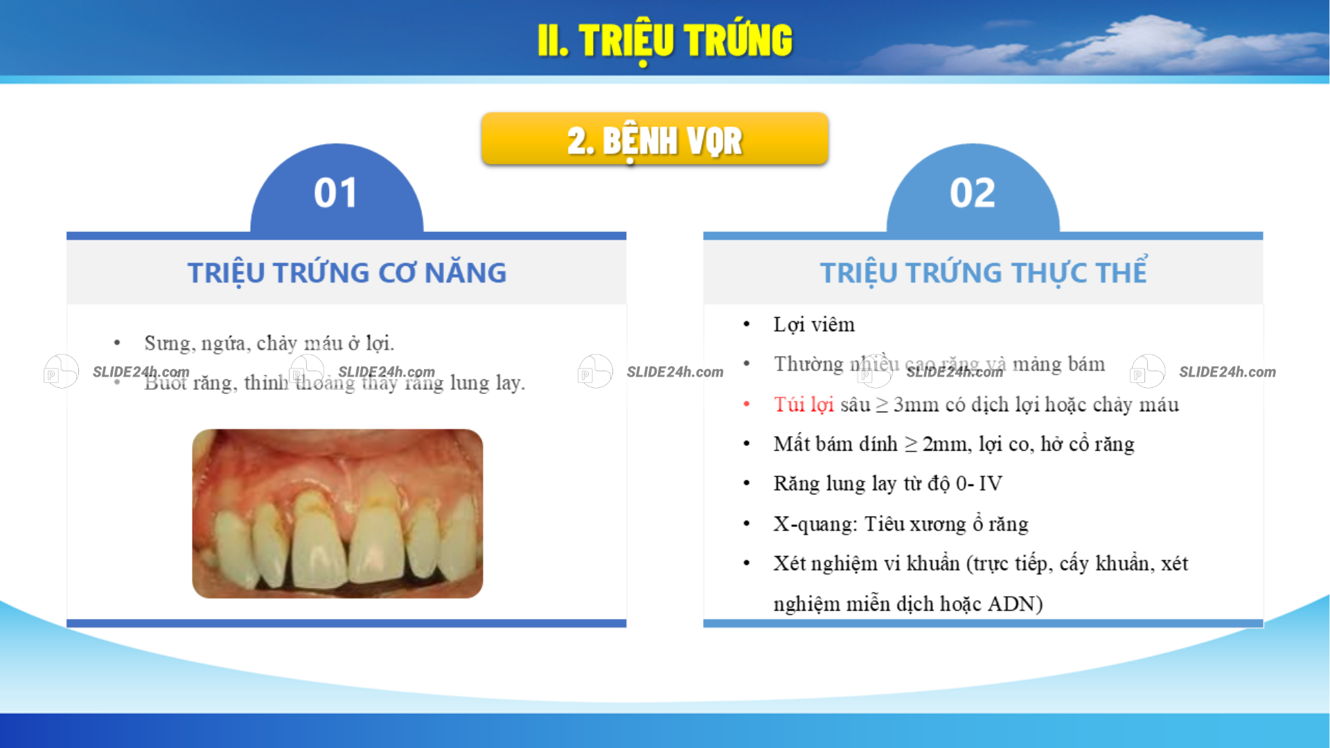 Các triệu chứng thường gặp của viêm quanh răng như sưng đỏ, chảy máu lợi, hôi miệng.