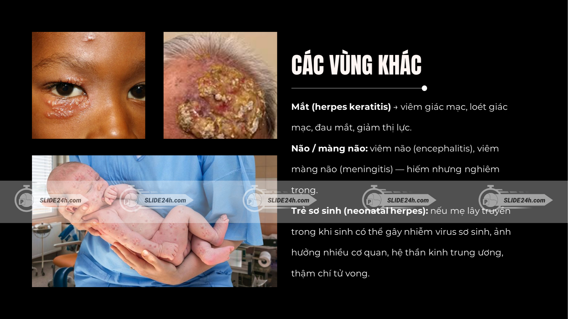 Các vùng chịu ảnh hưởng từ HSV