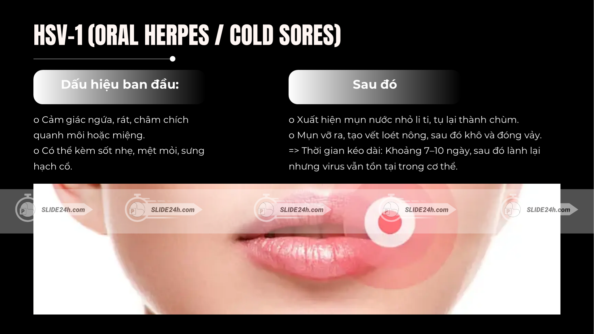 triệu chứng HSV-1